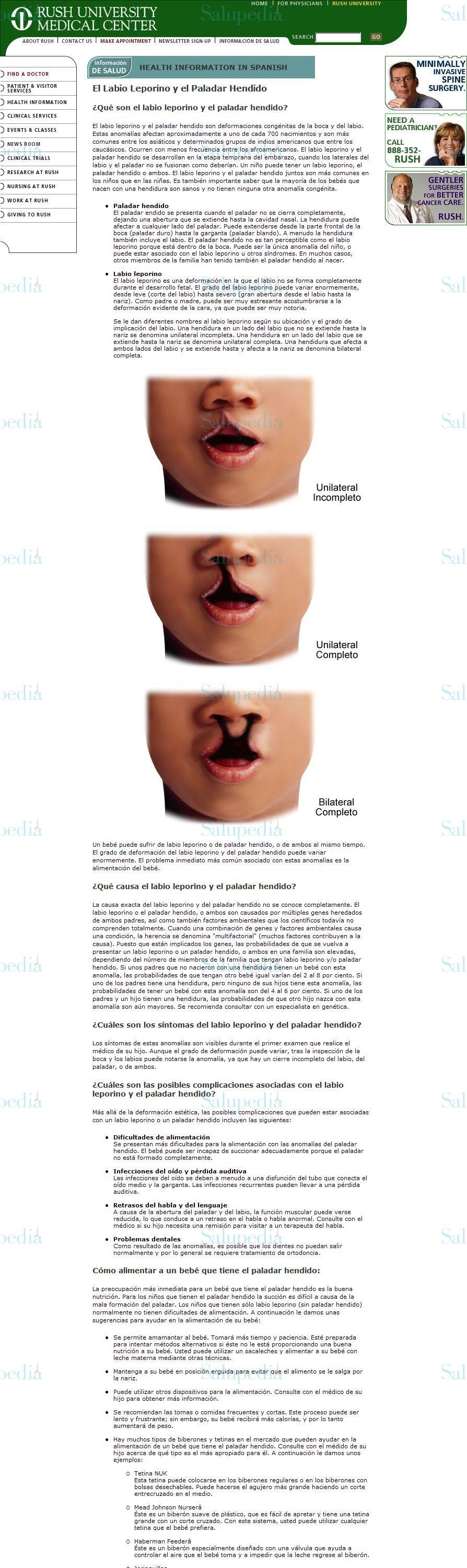 Cache grafica http://www.rush.edu/spanish/sadult/plassurg/cleft.html  