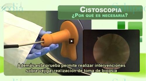 Cache grafica http://www.informarseessalud.org/contenido/tecnica_cistoscopia  