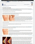 Captura de http://www.secpre.org/index.php?option=com_content&view=article&id=119:aumento-mamas&catid=36:cirugiaestetica&Itemid=75